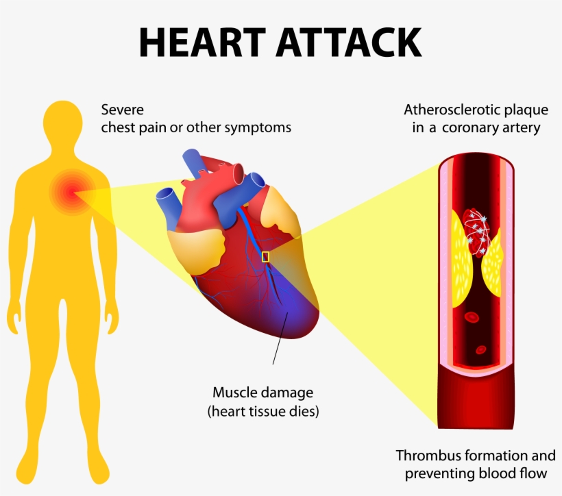 Heart-attack2 Adobestock - Myocardial Infarction Full Body - Free ...