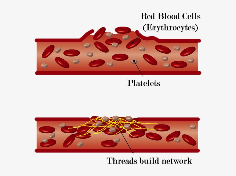 Blood Clot Formation - Damage Of Blood Vessels - Free Transparent PNG ...