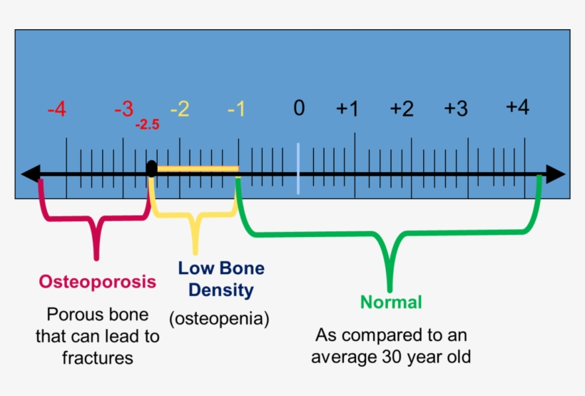 Understanding Bone Density Results - Free Transparent PNG Download - PNGkey