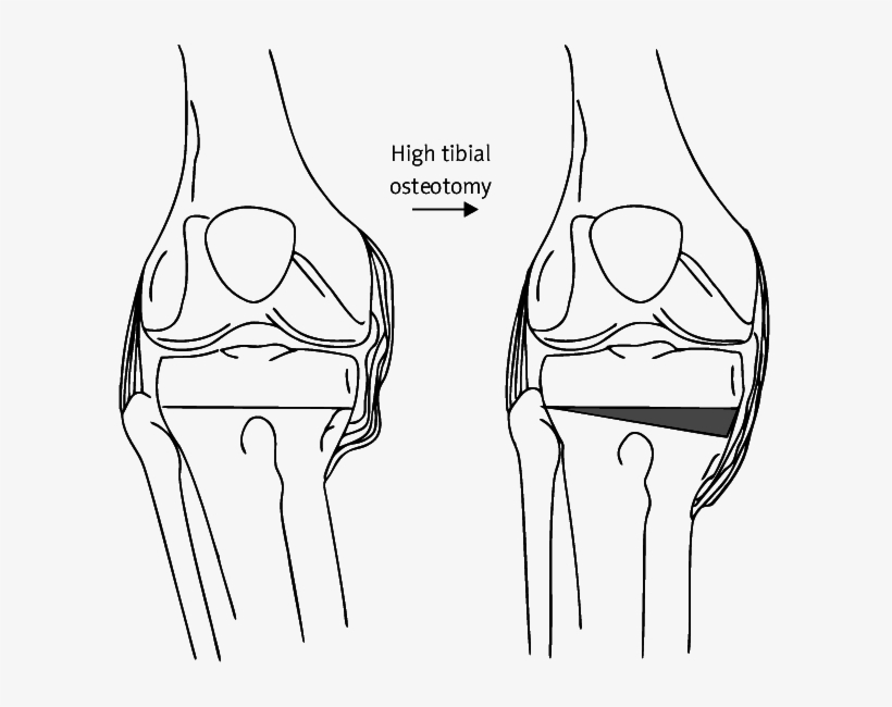 Example Of High Tibial Osteotomy Used For Varus Knee - High Tibial ...