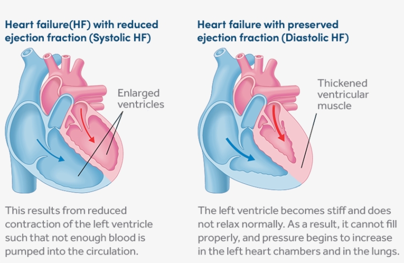 Two Types Of Heart Failure - Diagram - Free Transparent PNG Download ...