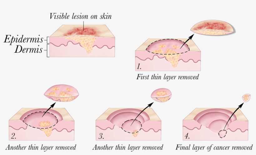 2010 Terese Winslow - Mohs Surgery - Free Transparent Png Download - Pngkey