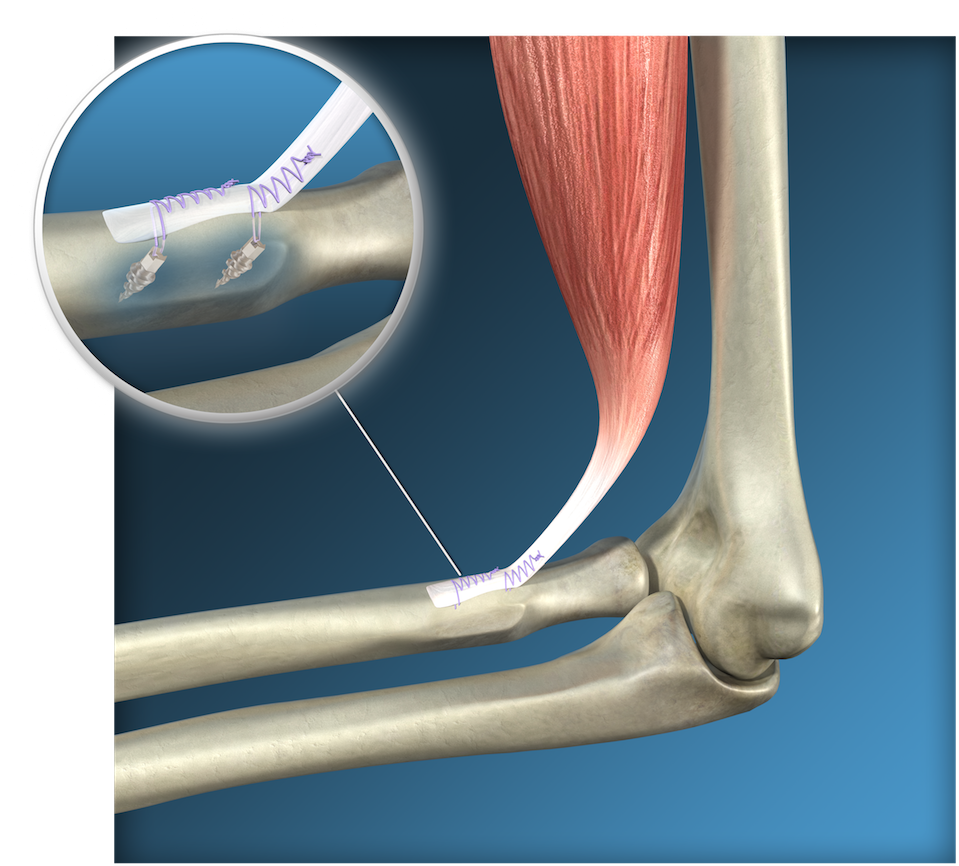 Endoscopic Distal Biceps Reinsertion Surgery, Toulouse - Rotura Del 