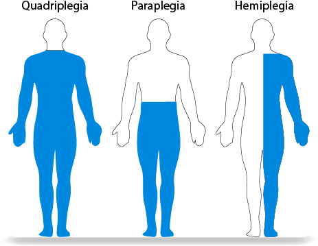 Download Conventional Method To Treat A Spinal Cord Injury - Paraplegia ...