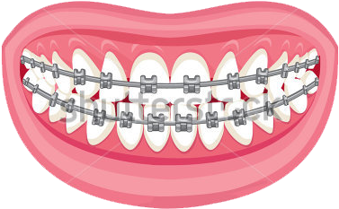 Braces And Aligners - Braces Cartoon No Background (450x358), Png Download