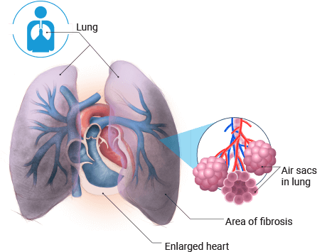 Download Idiopathic Pulmonary Fibrosis - Respiratory Care: Assessment ...