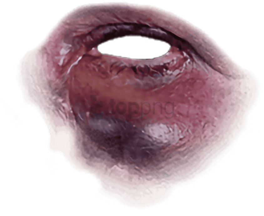 Black Eye Freetoedit Black Eye Bruise Png Free Transparent Png