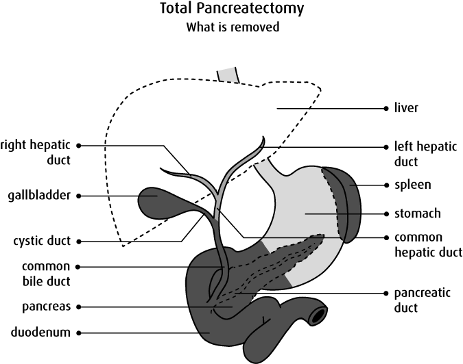 Download Diagram Of What Is Removed In A Total Pancreatectomy ...